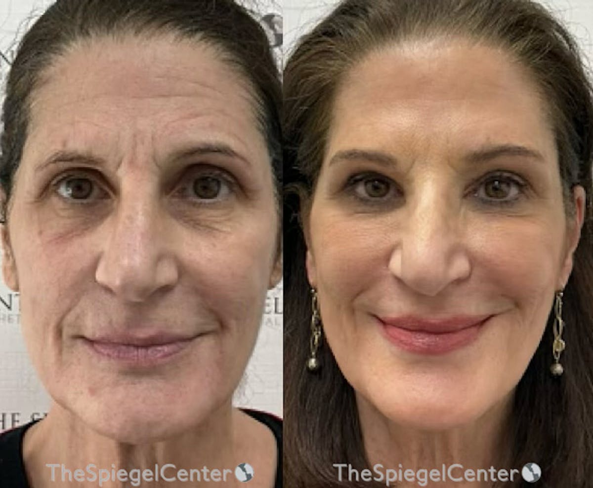 Liquid Face Lift Before & After Gallery - Patient 421793 - Image 1