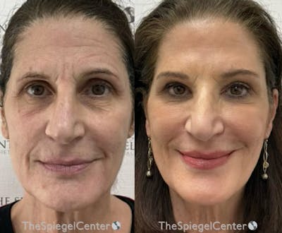 Liquid Face Lift Before & After Gallery - Patient 421793 - Image 1