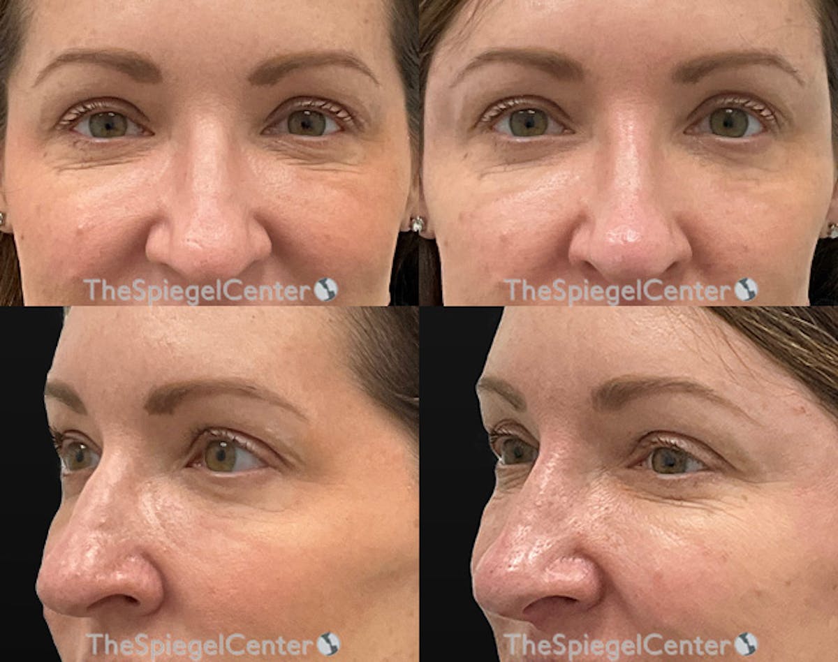 Non-Surgical Rhinoplasty / Nose Filler Before & After Gallery - Patient 189607 - Image 1