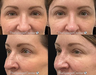 Non-Surgical Rhinoplasty / Nose Filler Before & After Gallery - Patient 189607 - Image 1