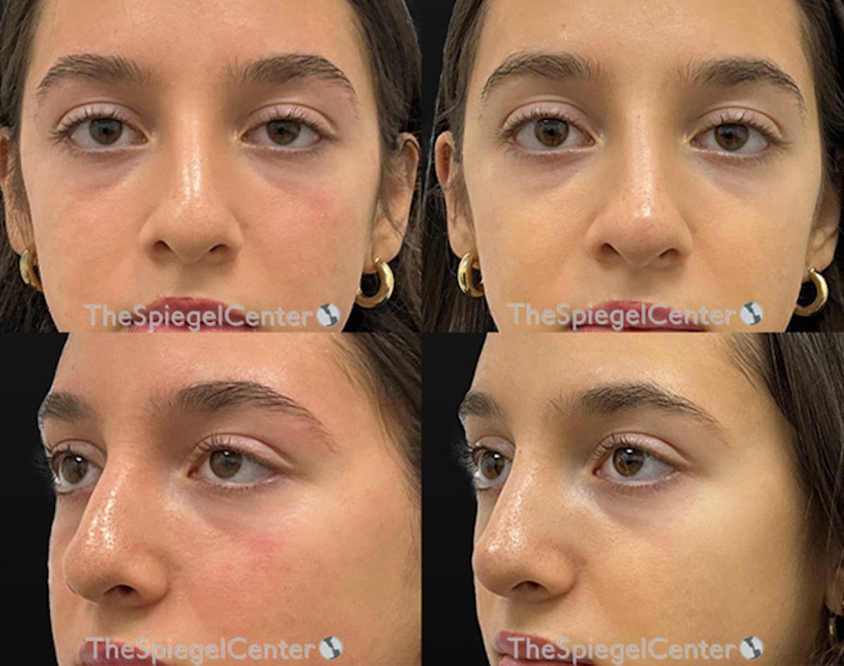 Non-Surgical Rhinoplasty / Nose Filler Before & After Gallery - Patient 335525 - Image 1