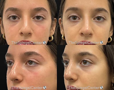 Non-Surgical Rhinoplasty / Nose Filler Before & After Gallery - Patient 335525 - Image 1
