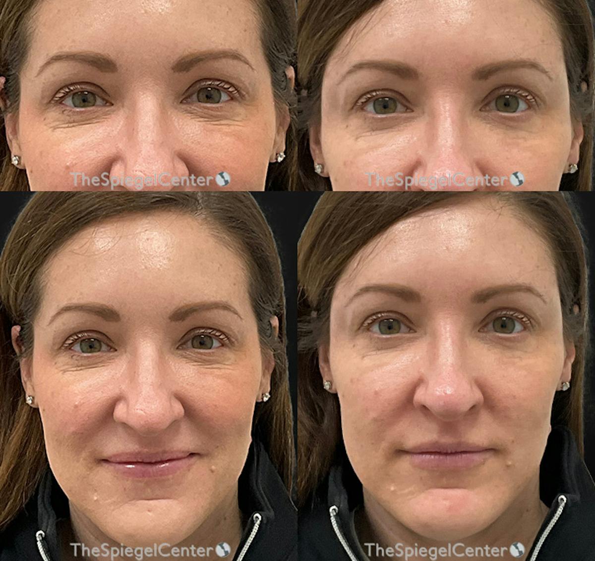 Temple Filler Before & After Gallery - Patient 413807 - Image 1