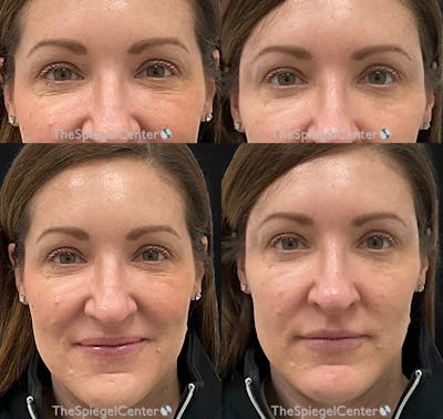 Temple Filler Before & After Gallery - Patient 413807 - Image 1