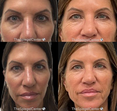 Temple Filler Before & After Gallery - Patient 751571 - Image 1