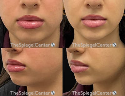 Chin Filler Before & After Gallery - Patient 413289 - Image 1