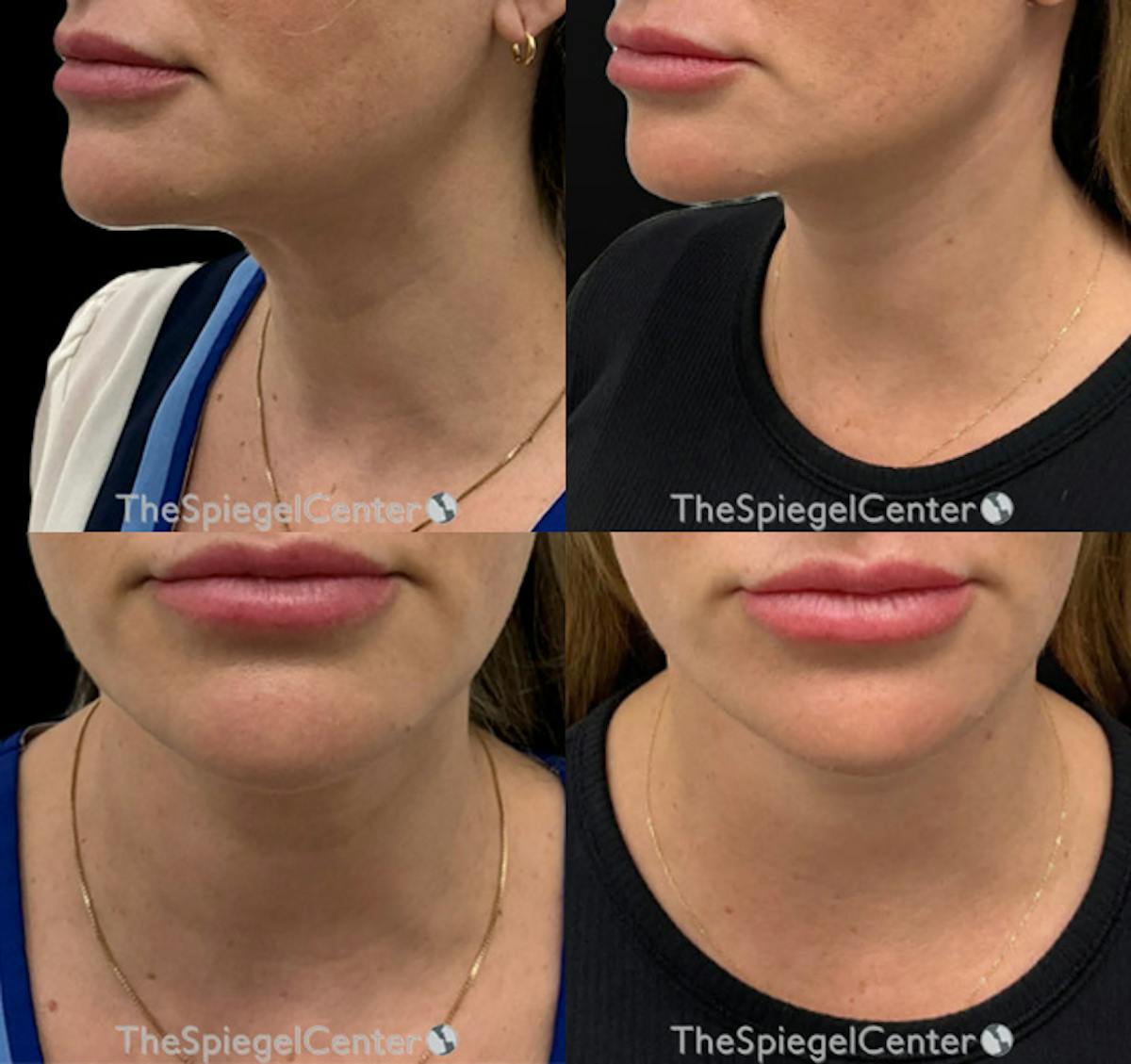 Neck Lift Before & After Gallery - Patient 178071 - Image 1