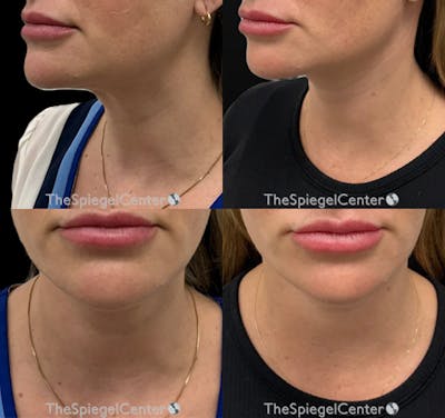 Neck Lift Before & After Gallery - Patient 178071 - Image 1