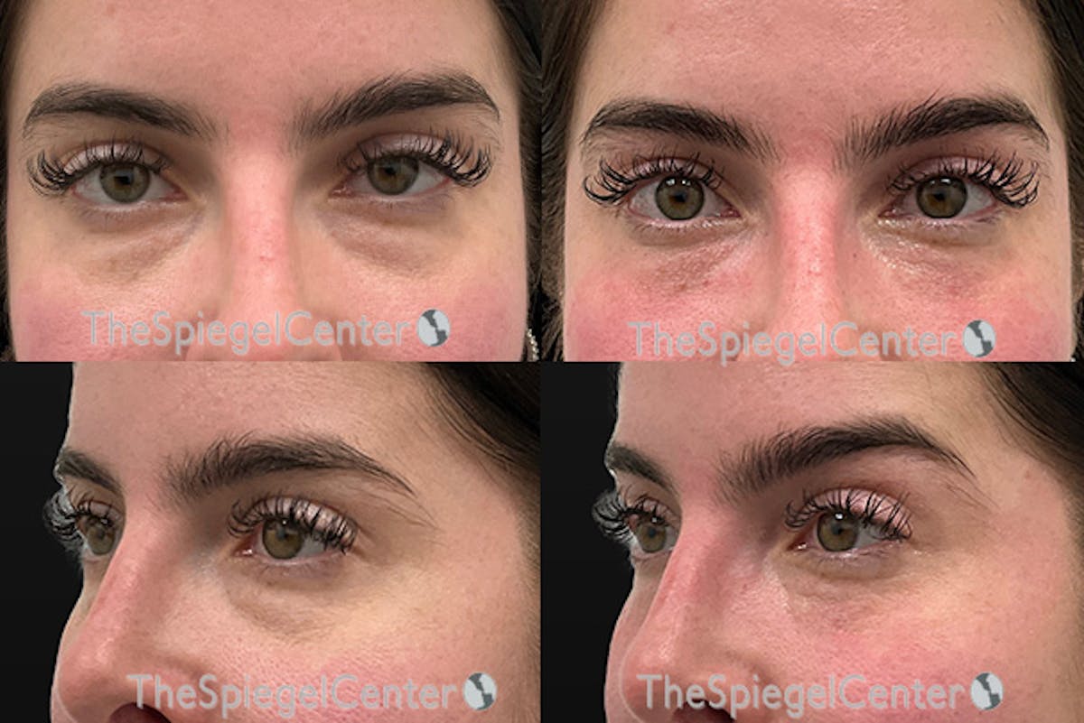 Tear Trough / Under Eye Fillers Before & After Gallery - Patient 245963 - Image 1