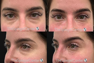 Tear Trough / Under Eye Fillers Before & After Gallery - Patient 245963 - Image 1