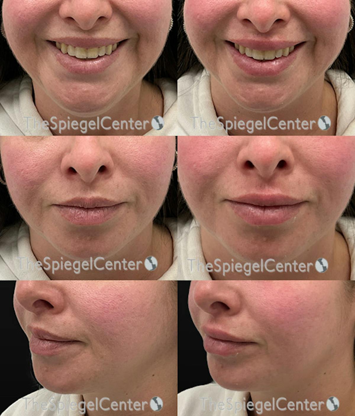 Lip Filler Before & After Gallery - Patient 286421 - Image 1