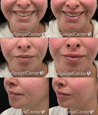 Lip Filler Before & After Gallery - Patient 286421 - Image 1