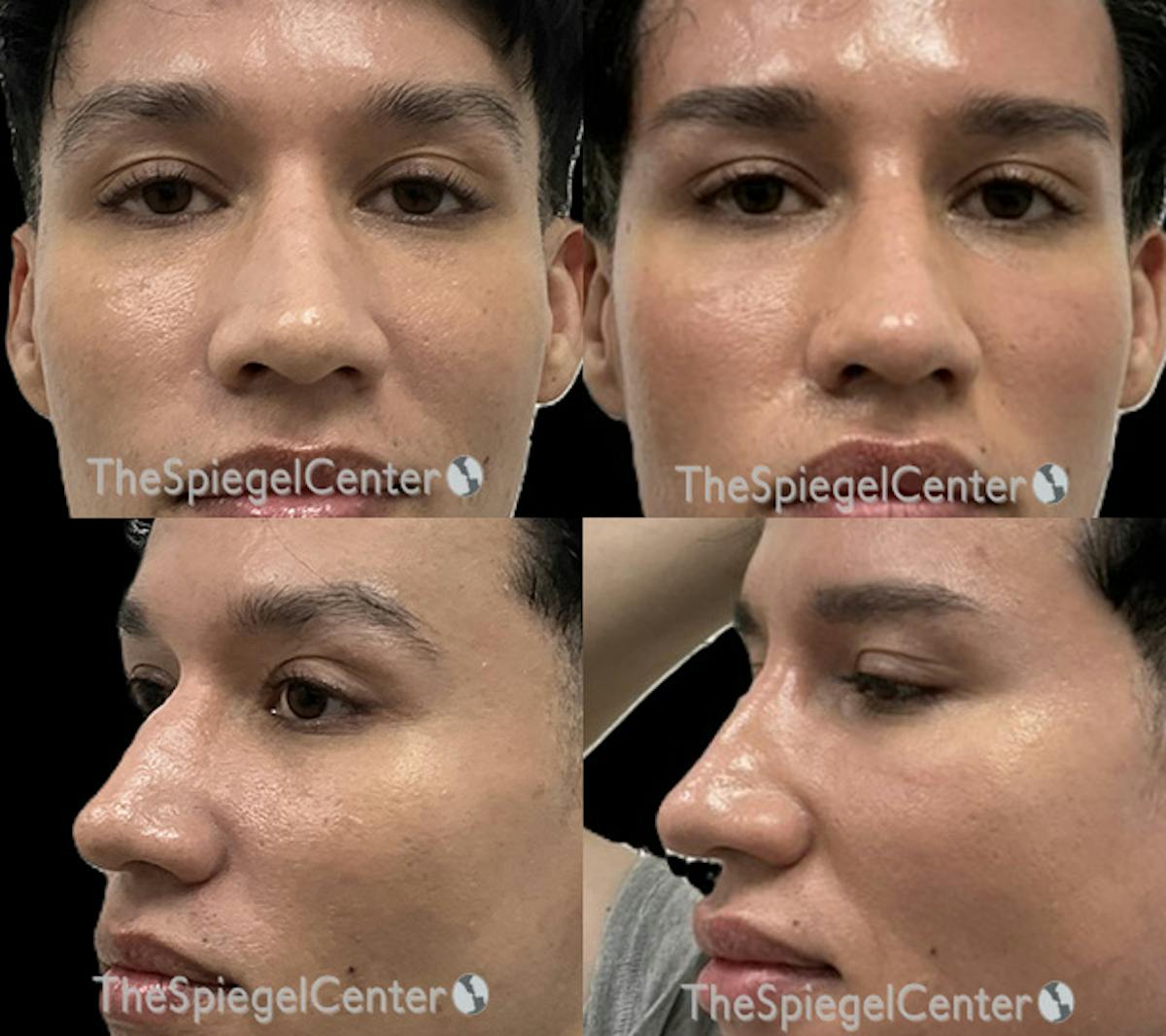 Non-Surgical Rhinoplasty / Nose Filler Before & After Gallery - Patient 255427 - Image 1
