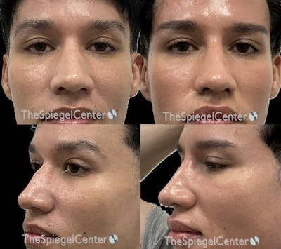 Non-Surgical Rhinoplasty / Nose Filler Before & After Gallery - Patient 255427 - Image 1