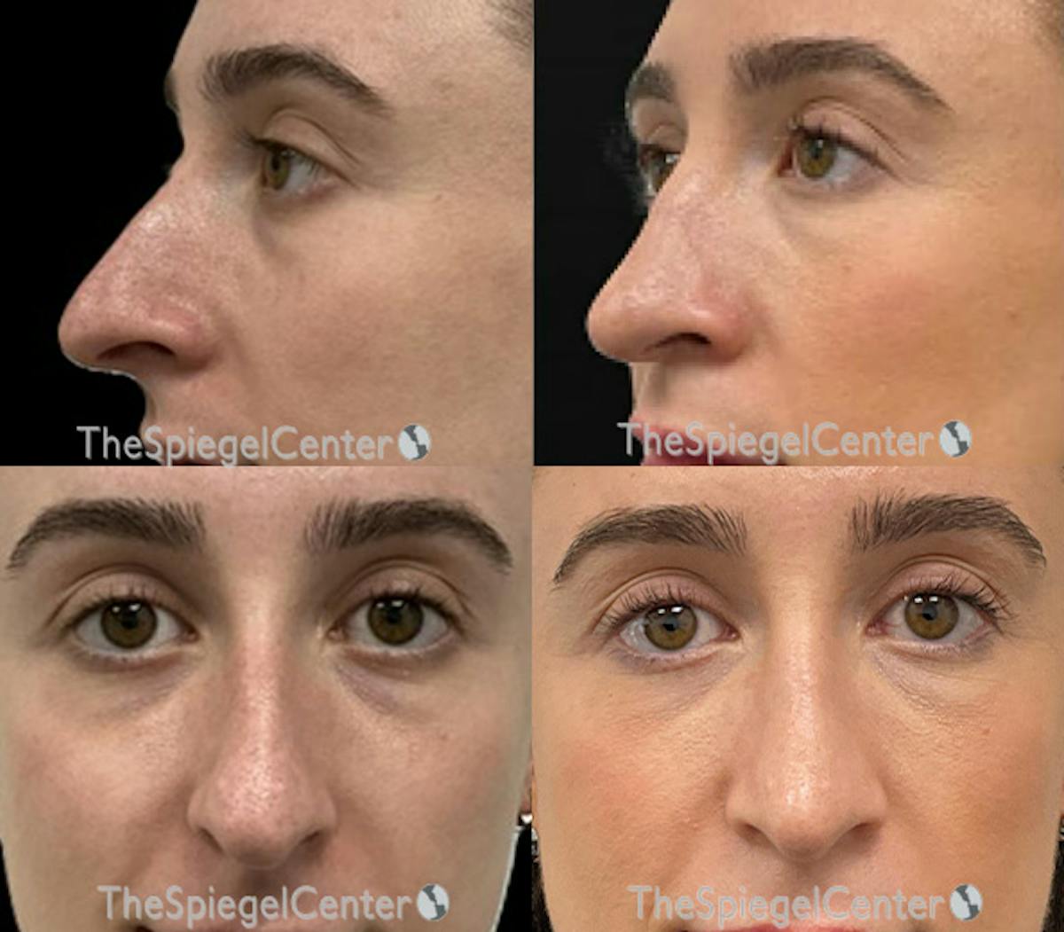 Rhinoplasty Before & After Gallery - Patient 334840 - Image 1
