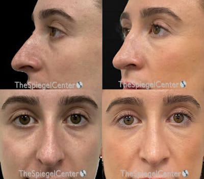 Rhinoplasty Before & After Gallery - Patient 334840 - Image 1