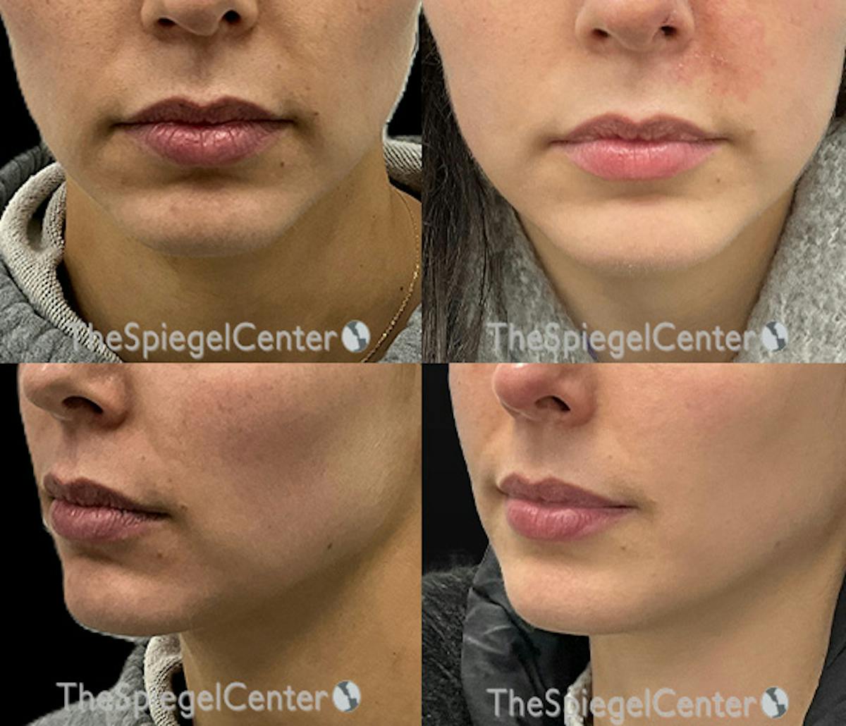 Chin Filler Before & After Gallery - Patient 121887 - Image 1