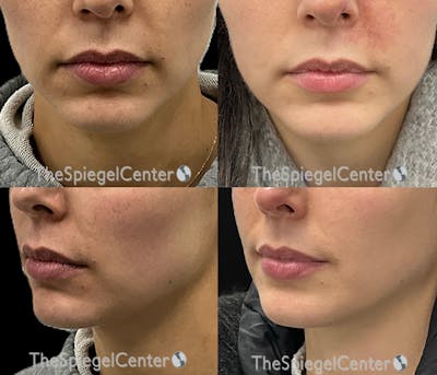 Chin Filler Before & After Gallery - Patient 121887 - Image 1