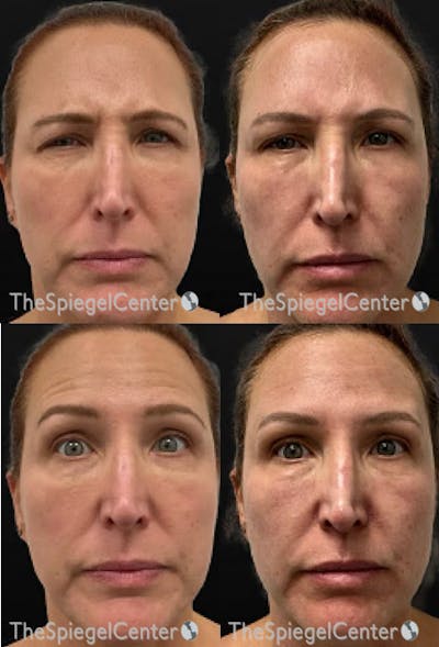 Botox / Dysport / Jeuveau / Xeomin Before & After Gallery - Patient 276415 - Image 1
