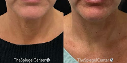 Neck Botox Before & After Gallery - Patient 239770 - Image 1