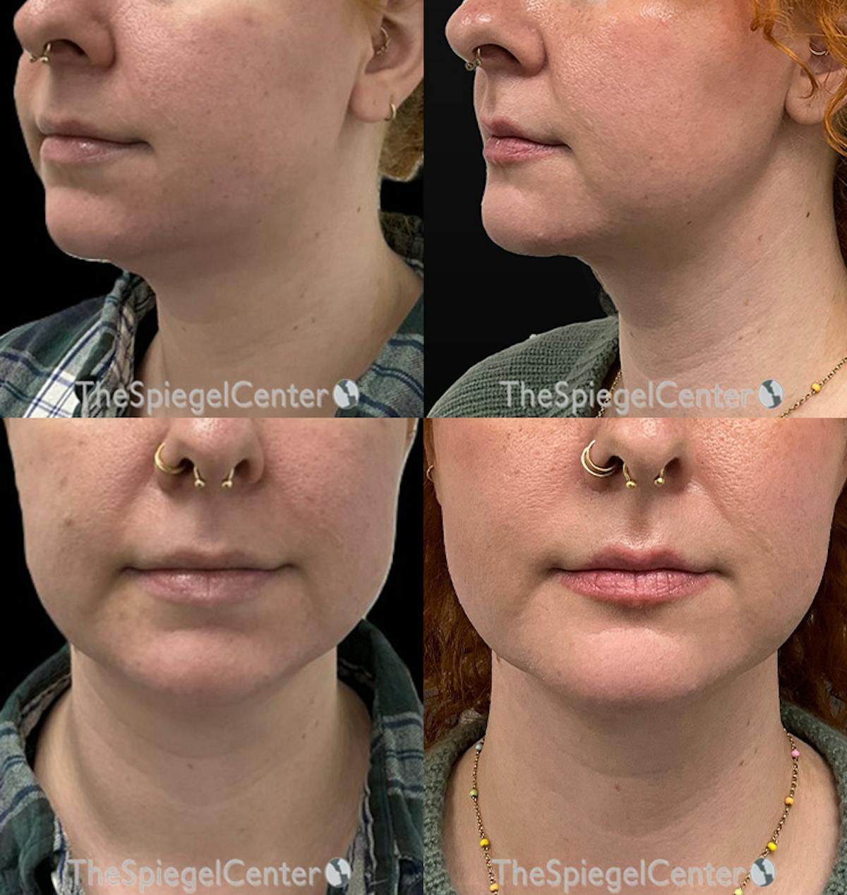 Neck Lift Before & After Gallery - Patient 312062 - Image 1