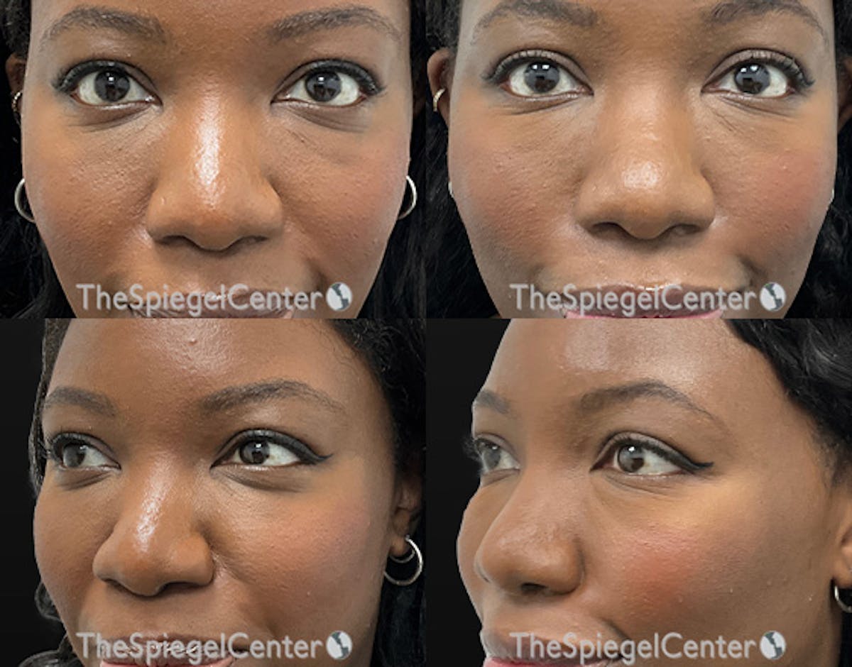 Tear Trough / Under Eye Fillers Before & After Gallery - Patient 171204 - Image 1
