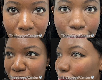 Tear Trough / Under Eye Fillers Before & After Gallery - Patient 171204 - Image 1