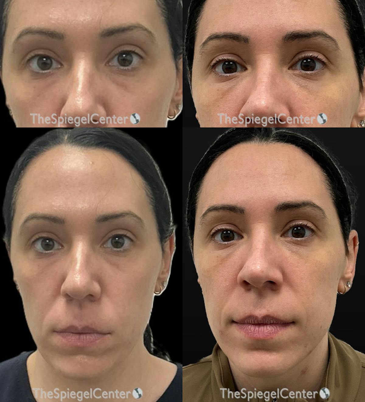 Temple Filler Before & After Gallery - Patient 390174 - Image 1