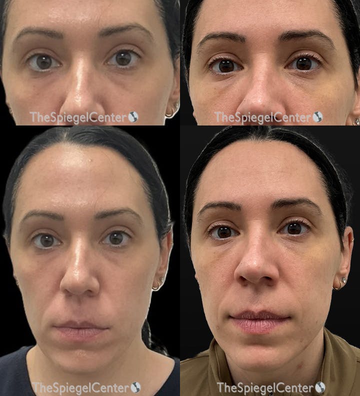 Temple Filler Before & After Gallery - Patient 390174 - Image 1