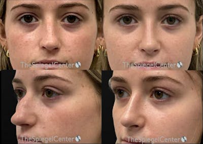 Rhinoplasty Before & After Gallery - Patient 319245 - Image 1