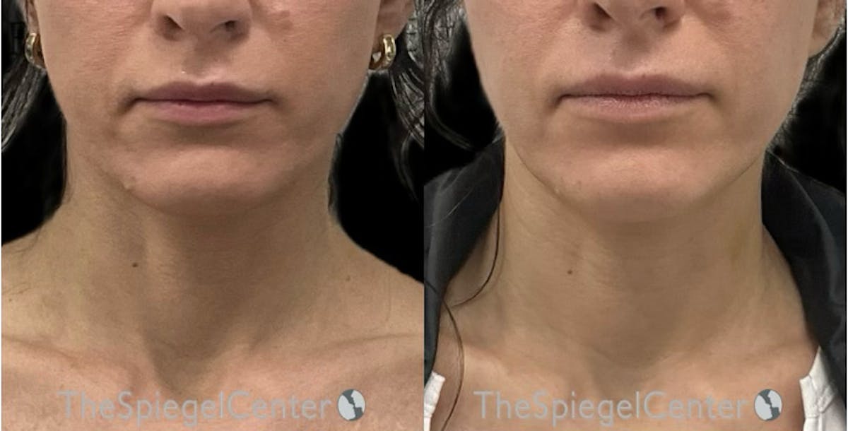 Neck Botox Before & After Gallery - Patient 247856 - Image 1