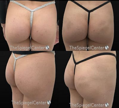 Liquid Butt Lift Before & After Gallery - Patient 374252 - Image 1