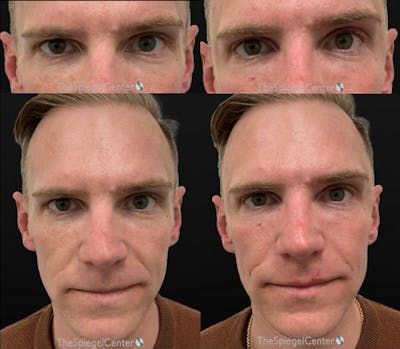 Temple Filler Before & After Gallery - Patient 117366 - Image 1