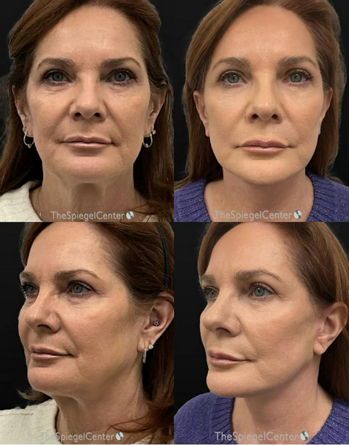 Facelift Before & After Gallery - Patient 198078 - Image 1