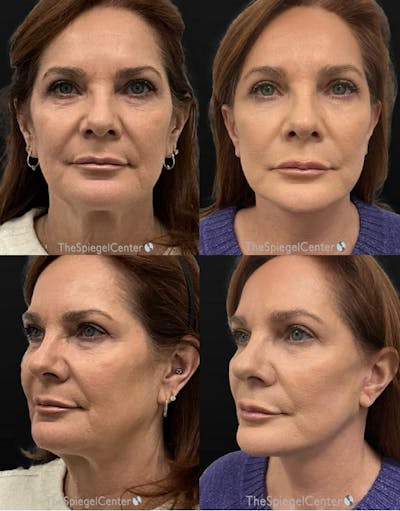 Facelift Before & After Gallery - Patient 198078 - Image 1