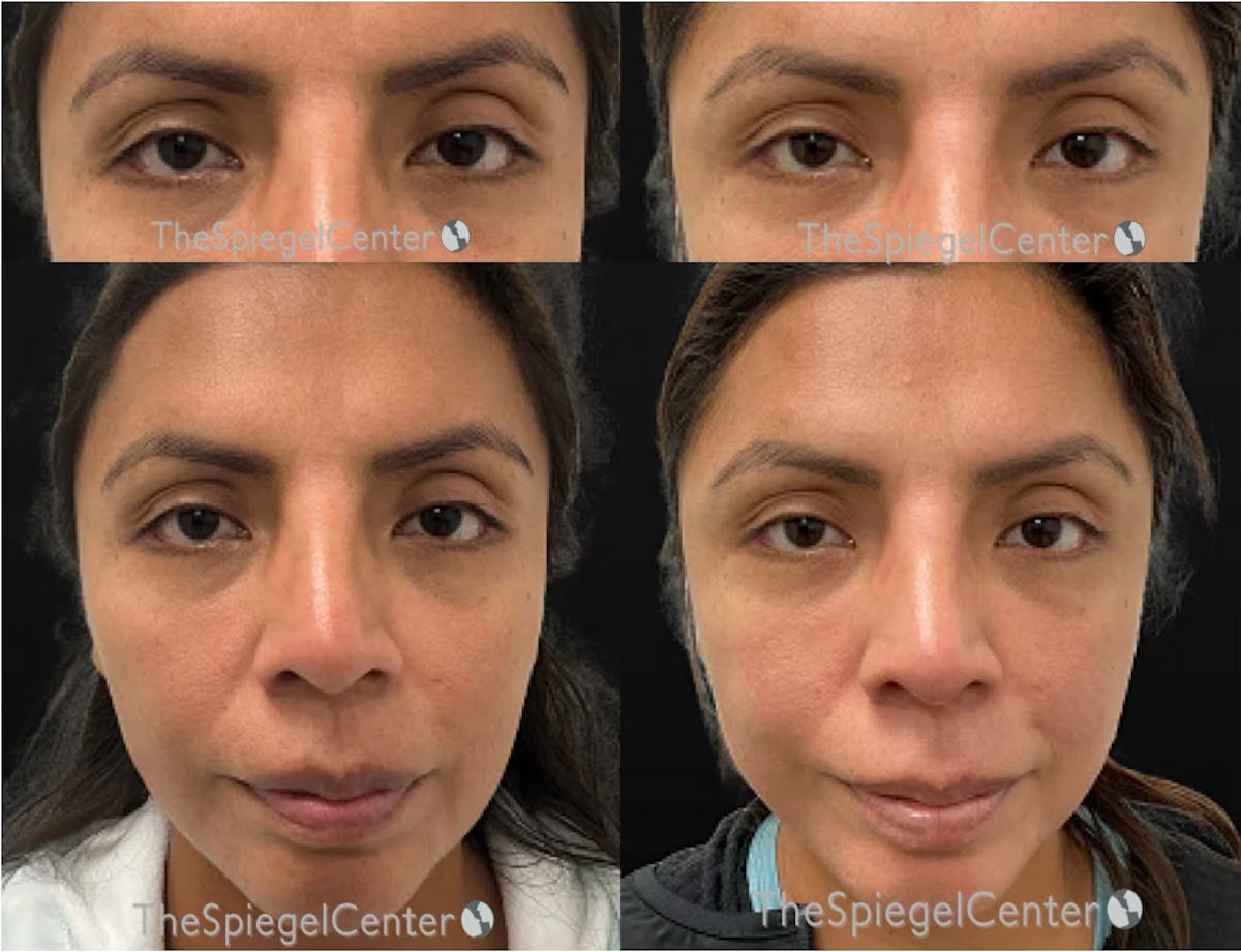 Temple Filler Before & After Gallery - Patient 641597 - Image 1