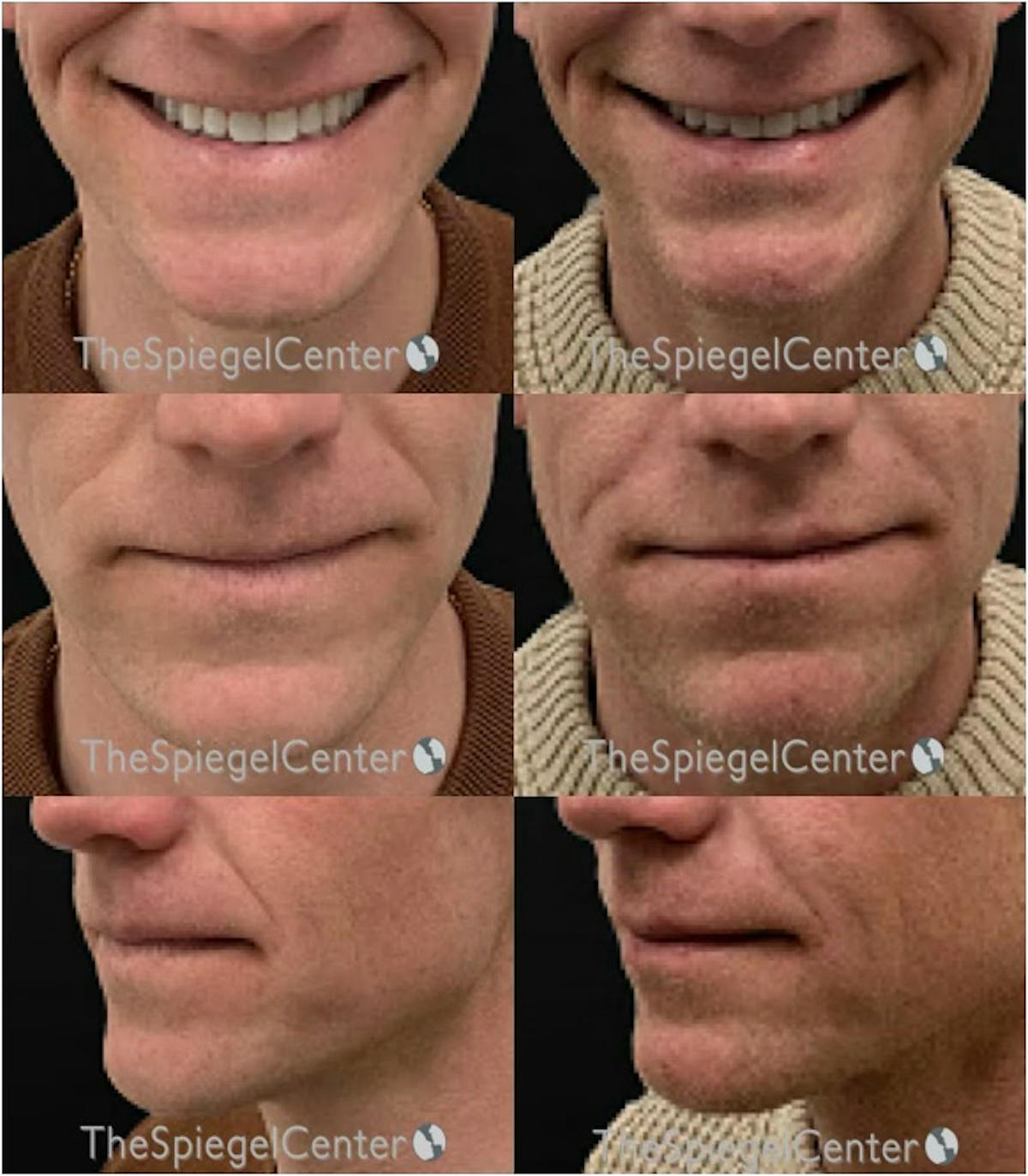 Lip Filler Before & After Gallery - Patient 389063 - Image 1