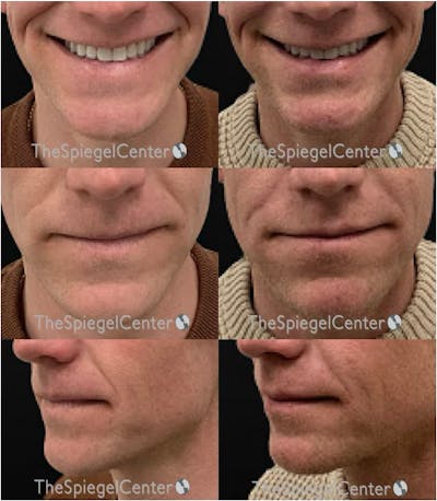 Lip Filler Before & After Gallery - Patient 389063 - Image 1
