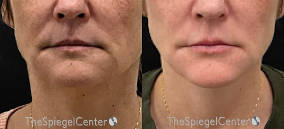 DOA Botulinum Before & After Gallery - Patient 323972 - Image 1