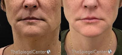 DOA Botulinum Before & After Gallery - Patient 323972 - Image 1