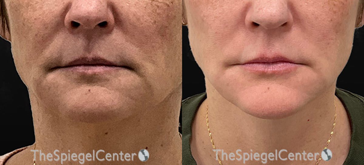 DOA Botulinum Before & After Gallery - Patient 323972 - Image 1