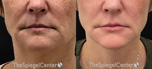 DOA Botulinum Before & After Gallery - Patient 323972 - Image 1