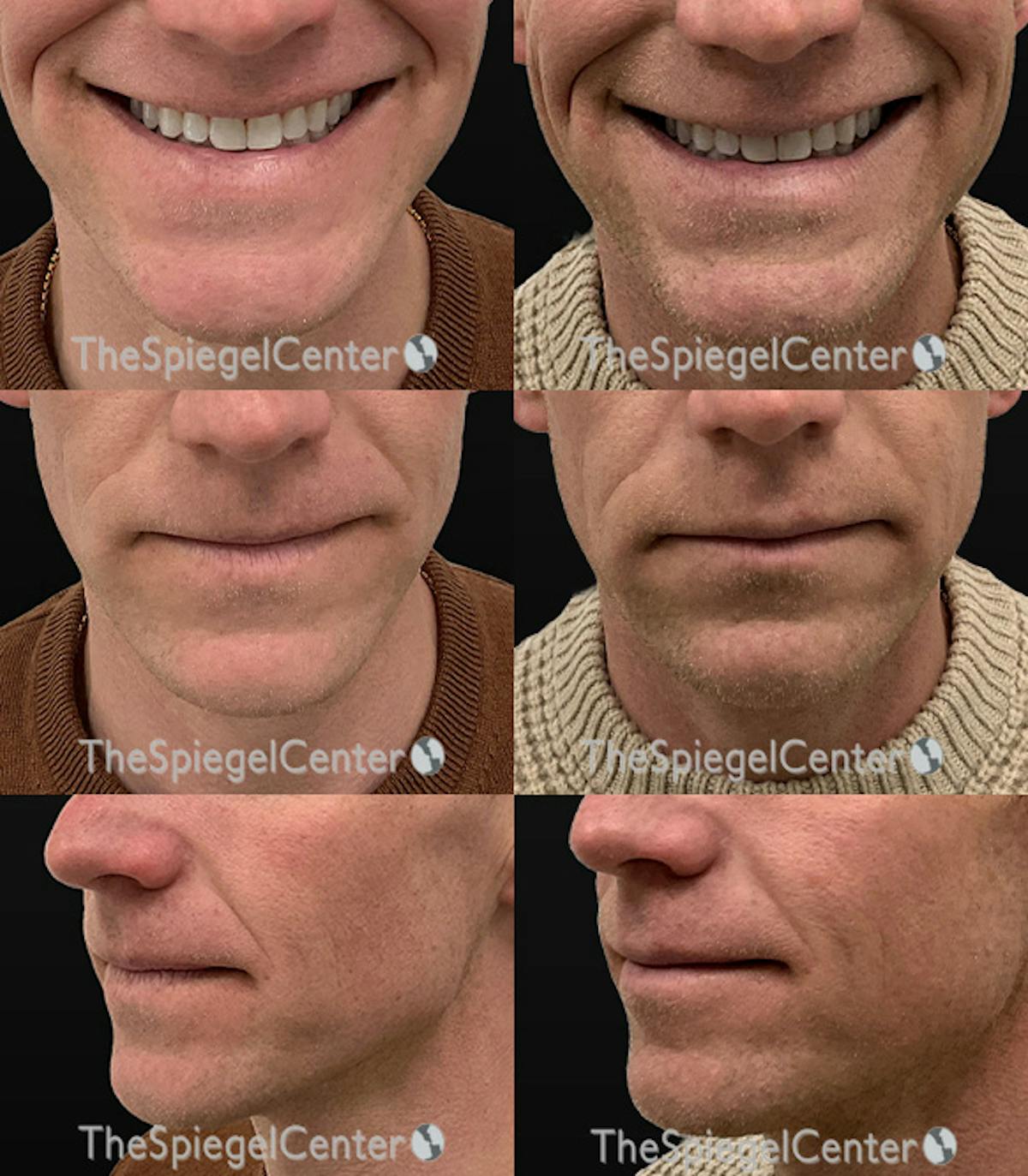 Lip Filler Before & After Gallery - Patient 389063 - Image 1