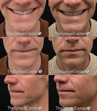 Lip Filler Before & After Gallery - Patient 389063 - Image 1