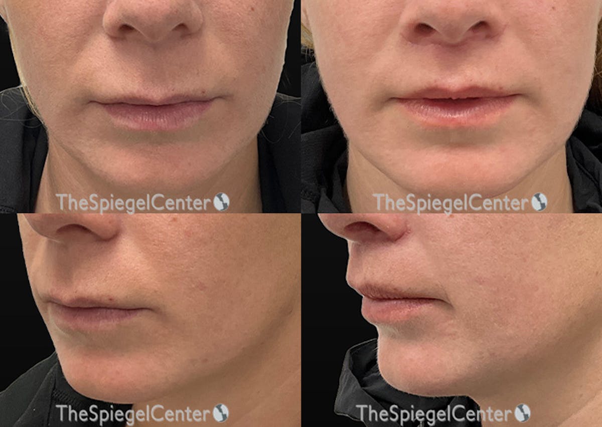 Lip Lift Before & After Gallery - Patient 127614 - Image 1