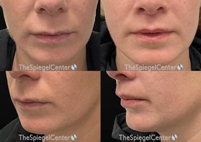 Lip Lift Before & After Gallery - Patient 127614 - Image 1