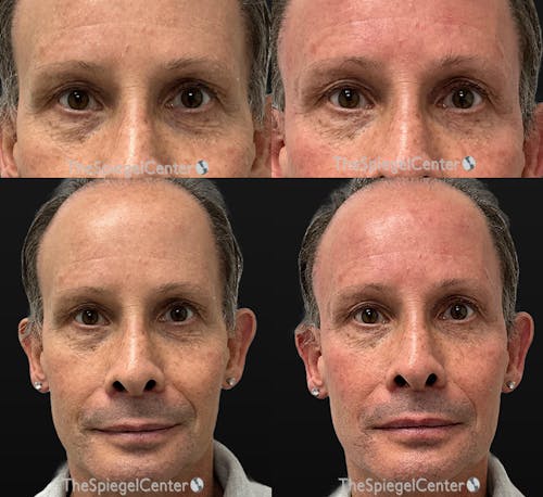 Temple Filler Before & After Gallery - Patient 274147 - Image 1
