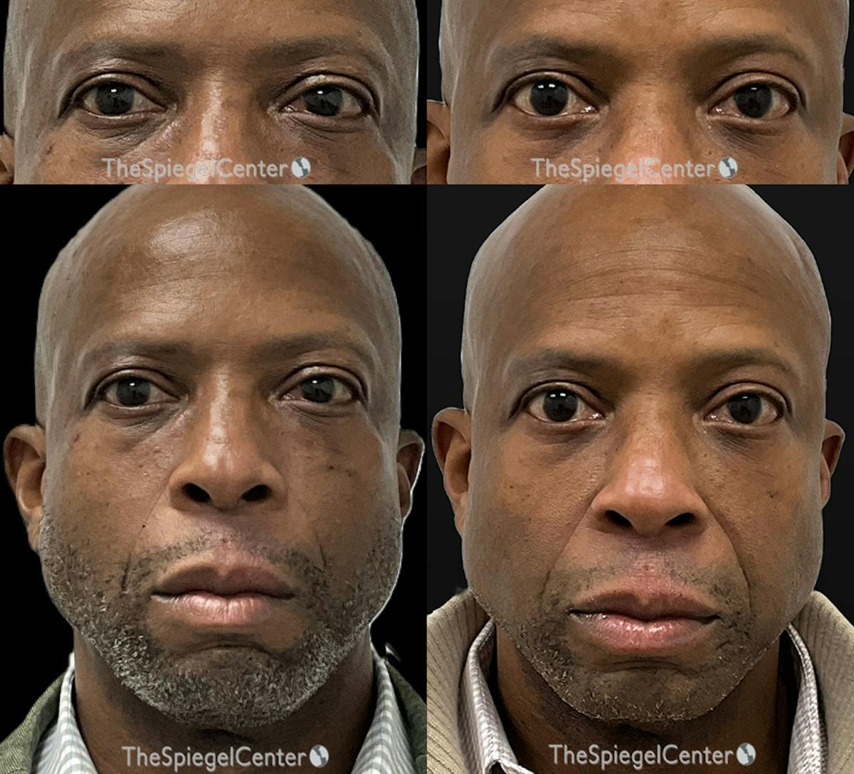 Temple Filler Before & After Gallery - Patient 193711 - Image 1