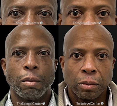 Temple Filler Before & After Gallery - Patient 193711 - Image 1