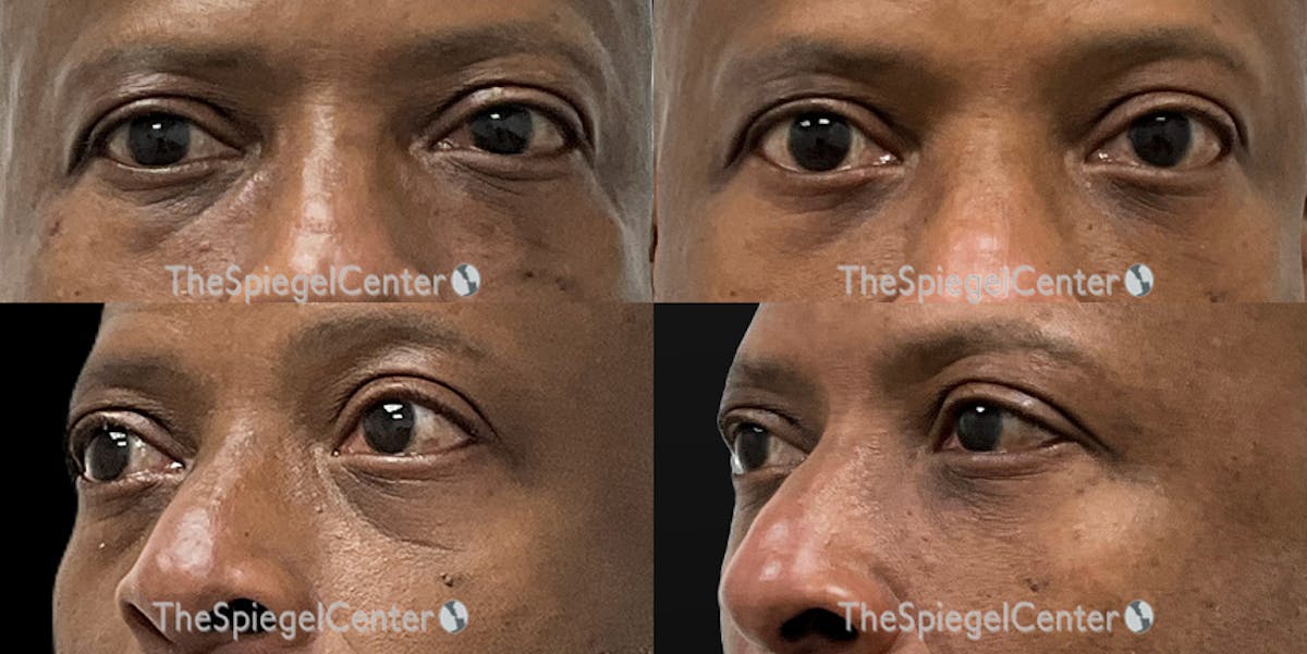 Tear Trough / Under Eye Fillers Before & After Gallery - Patient 267463 - Image 1